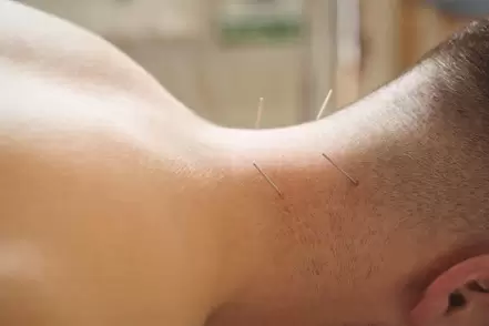 Phương pháp châm cứu trong điều trị rối loạn tiền đình